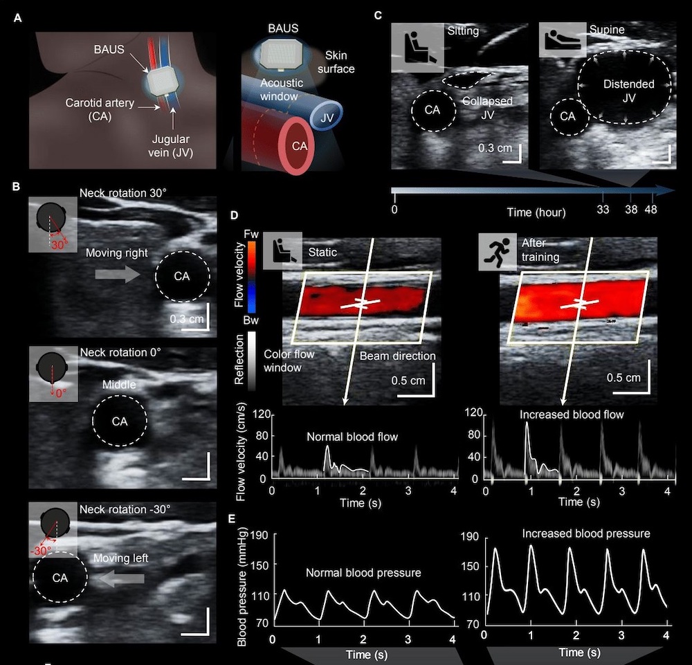 Editor's Blog Layered patch brings mobility to ultrasound imaging Global